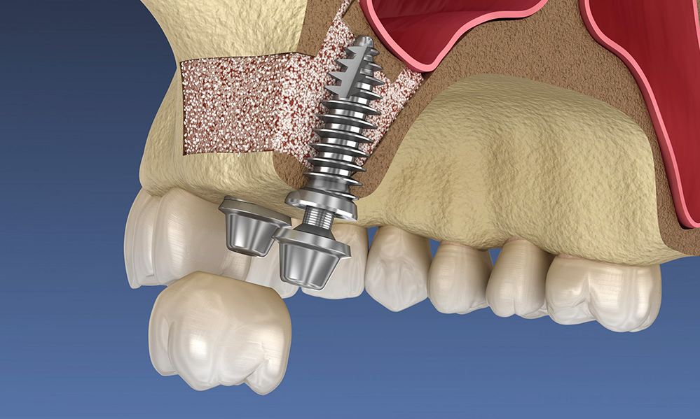 sinus1